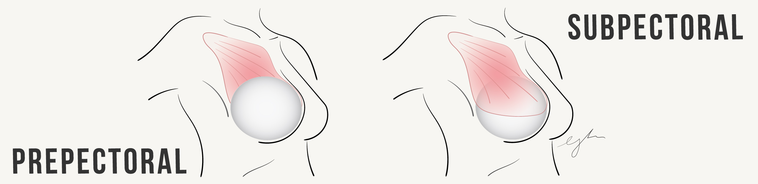 prepectoral vs subpectoral